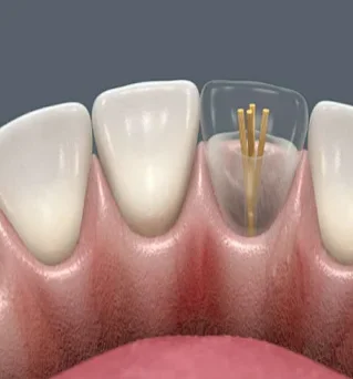 Восстановление зуба с использованием анкерного штифта