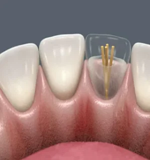 Фото для Восстановление зуба с использованием анкерного штифта