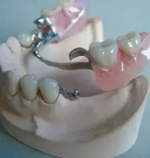 Фото для Бюгельное протезирование зубов