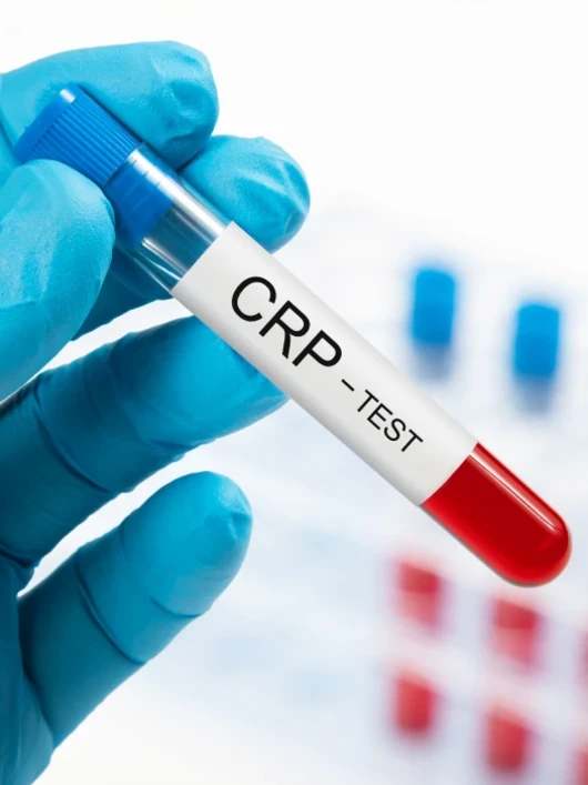 
Определение уровня С - реактивного белка крови