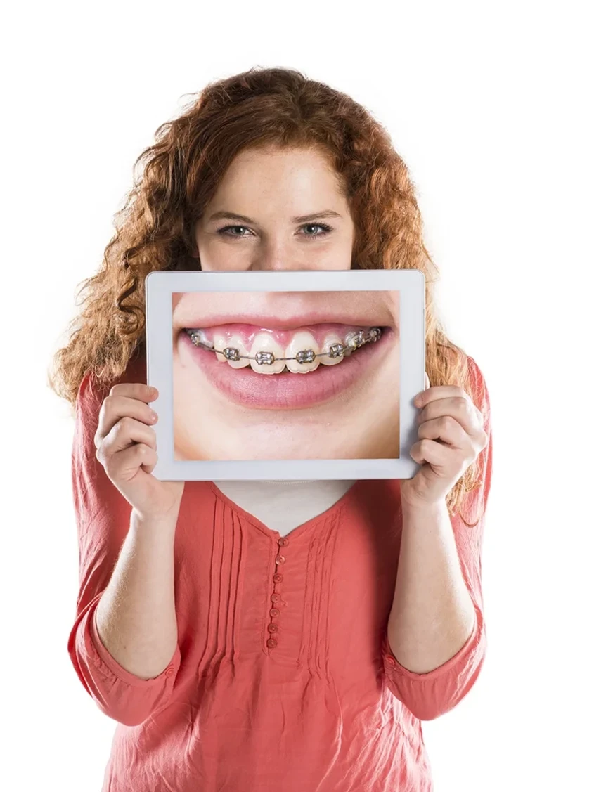 Ортодонтическое лечение брекетами Damon Clear