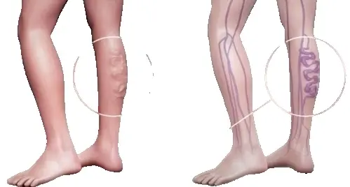 Триплексное сканирование вен нижних конечностей