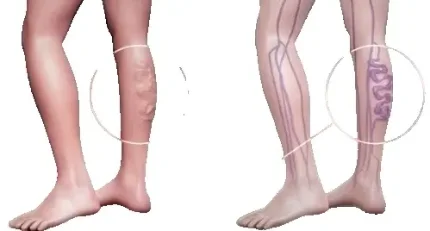 Фото для Триплексное сканирование вен нижних конечностей