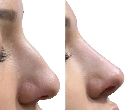 Смешанная коррекция носа, коррекция наружного носа (Устранение дефекта наружного носа)