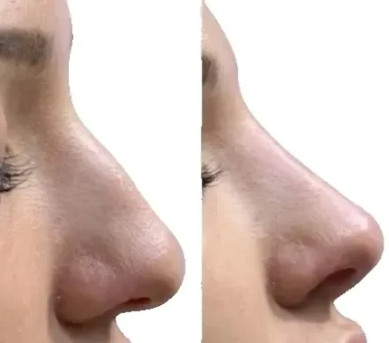 Фото для Смешанная коррекция носа, коррекция наружного носа (Устранение дефекта наружного носа)