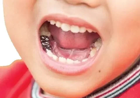 Восстановление молочного зуба стандартной металлической коронкой
