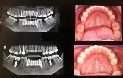 имплантация зуба А-Стом