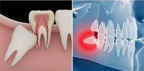 Услуги стоматолога: простое удаление зуба «мудрости»