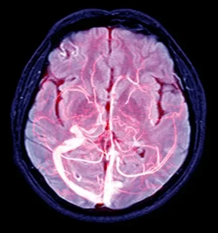Фото для МРТ вен головного мозга