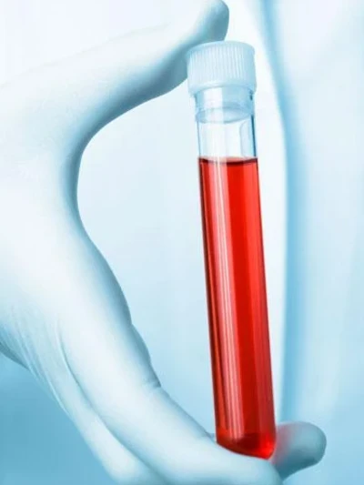 Анализ крови на вирус Эпштейна-Барр (NA), IgG к капсидному антигенуБ ИФА