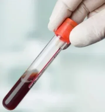 Анализ крови на гормон Пролактин (Prolactin) (+ дополнительный тест на макропролактин при результате пролактина выше 700 мЕд/л)