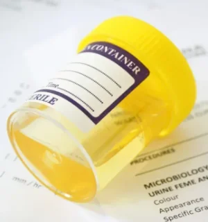 Анализ мочи общий с микроскопией осадка